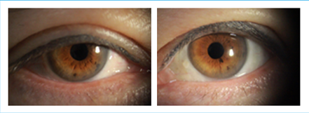 결막성형 수술1