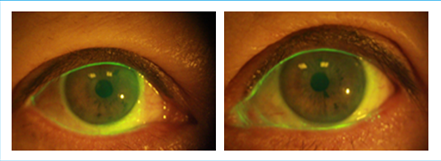 결막성형 수술2