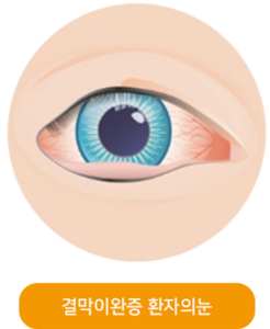 결막이완증 환자 눈