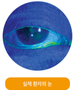 실제 환자의 눈