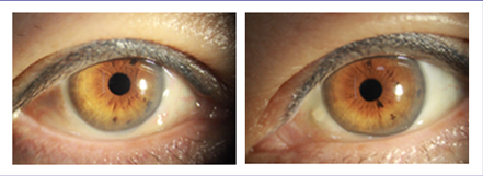 결막성형 수술전1