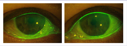 결막성형 수술전2