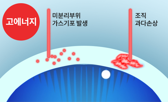 3세대 시력교정술