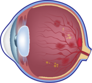 증식성 당뇨망막병증