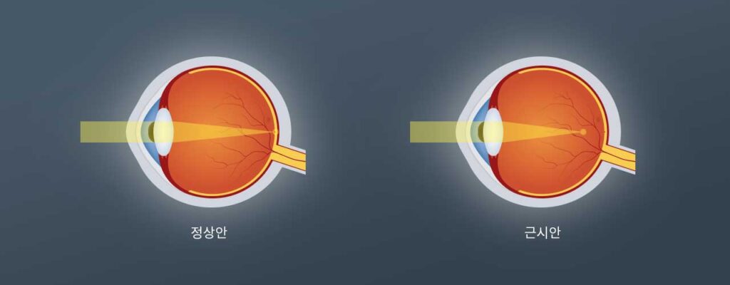 근시란